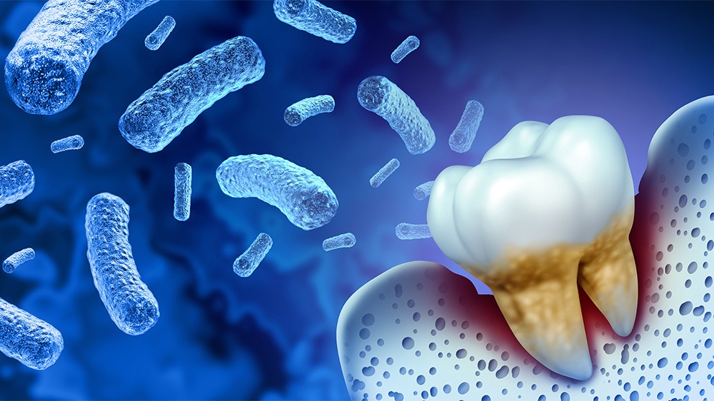 Eine Grafik von Bakterien wie Sie dem Zahn im Zahnfleisch nahe kommen.