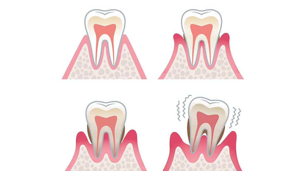 Auf vier Grafiken sieht man wie ein Zahn nach und nach loser im Zahnfleisch liegt und zum Schluss anfängt zu wackeln.