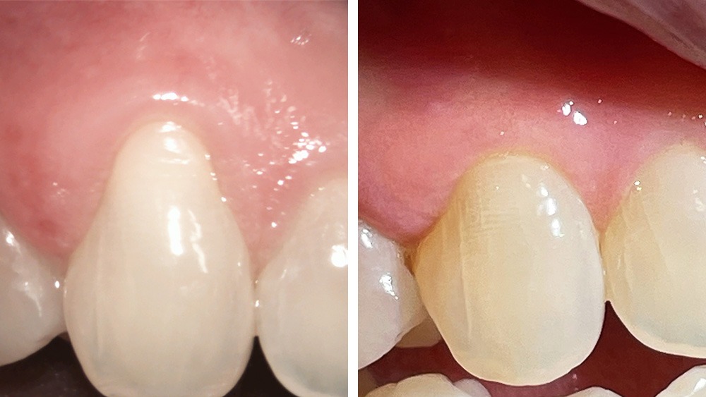 Vorher-Nachher-Vergleich, links ein Zahn mit offenem Zahnhalz und rechts ein Zahn mit Zahnfleisch über den Zahnfleisch.